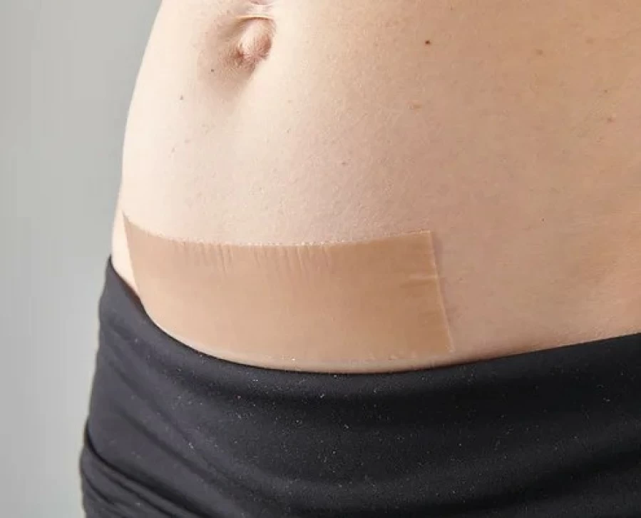 Hot Myscar Caesarean Silicone Strips The Active